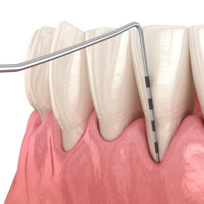 치과에서 절대 말해주지 않는다는 가성비 치료, 잇몸치료